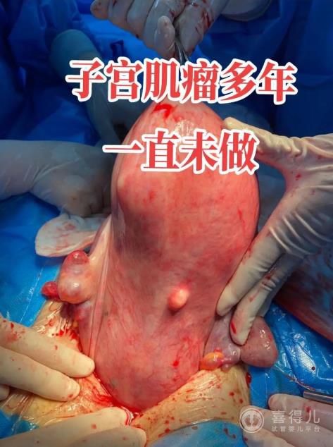 子宫肌瘤.jpg